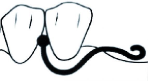 Crochets Boule SCHEU DENTAL